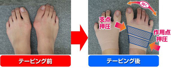 外反母趾の改善率91 9 姫路市飾磨区の新井接骨院は メディア実積も豊富な地元で人気の老店です